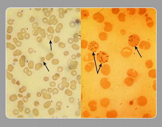 Stanley Schrier, Stanford University Medical Center