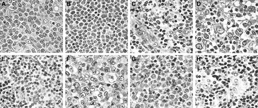 Figure 2. Histopathologic features of cells. (HE staining) (A) PTCL, unspecified type (diffuse large cell type); (B) lymphoblastic lymphoma; (C) AILD; (D) ALCL; (E) PTCL, unspecified type (diffuse medium-sized cell type); (F) ATLL; (G) ATLL; (H) PTCL, unspecified type (Lennert lymphoma). Original magnification, × 400.