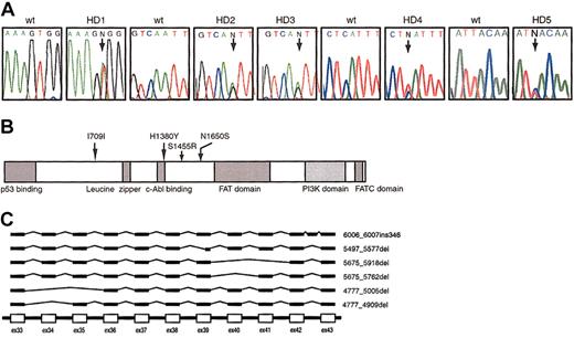 Figure 1. Polymorphic variations of the ATM gene. (A) DNA sequence electrophoretograms with arrows showing the positions of the heterozygous germ line SNPs at 4365T>A in patient HD1, 4949A>G in patients HD2 and HD3, 4138C>T in patient HD4, and 2127T>C in patient HD5. The first codon of the ORF was designated +1. “N” represents indistinguishable nucleotides. (B) Schematic diagram of the ATM protein. The locations of amino acid changes are indicated by arrows in relation to the predicted domains. (C) Schematic diagram of variant species of ATM mRNA found in cells from patient HD6.