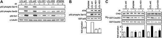 Figure 2. ATM-dependent p53 phosphorylation after DNA damage. (A) Western blot detection of Ser15-phosphorylated p53, Ser20-phosphorylated p53, total p53, and α-tubulin (as a control for the amount of cell lysate loaded) in lysates of immortalized lymphoblastic cells from healthy subjects (LCL-wt1 and LCL-wt2), patients with HD (LCL-HD1 and LCL-HD2), and a patient with AT (AT65RM), before (–) and 30 minutes after (+) X-irradiation (IR; 5 Gy) of the cells in culture. Representative data from 3 independent experiments are shown. (B) Western blot detection of GST-p53 phospho-Ser15 in an in vitro phosphorylation assay with immunoprecipitated ATM from AT cells (AT65RM), wild-type cells (LCL-wt1), and HD cells (LCL-HD1 and LCL-HD2); equivalence of loading of GST-p53 is shown by Coomassie brilliant blue staining (third panel). Extents of phosphorylation of recombinant GST-p53 (1-100) are shown relative to that of LCL-wt1 (= 1) (bottom graph). Data represent mean values from 3 independent experiments. Equal amounts of ATM protein (top panel) were immunoprecipitated from LCL-wt1, LCL-HD1, and LCL-HD2; no ATM protein was immunoprecipitated from AT65RM. (C) Whole lysates of cells from a healthy subject (LCL-wt2), patients HD1 and HD2 (LCL-HD1 and LCL-HD2), and a patient with AT (AT65RM) were immunoprecipitated with anti–Chk2 antibody before (–) and 1 hour after (+) X-irradiation (5 Gy). Immunoprecipitated Chk2 protein (detected by Western blotting with anti–Chk2 antibody; top panel) was used in an in vitro kinase assay with recombinant GST-Cdc25C as the substrate (detected with Coomassie brilliant blue; third panel), phosphorylation of which is shown by 32P incorporation (by autoradiography; second panel). Extents of phosphorylation of recombinant GST-Cdc25C (167-267) after X-irradiation are shown relative to that before X-irradiation (= 1) (bottom graph). Data represent mean values from 3 independent experiments.