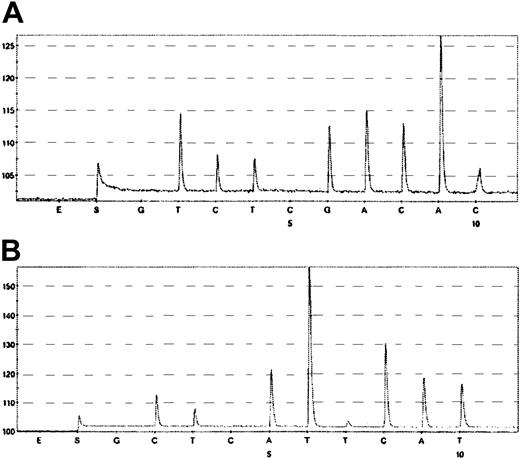 Figure 7. Loss of heterozygosity analysis by pyrosequencing. (A) Pyrogram of the coding SNP in the ATM gene (codon 4949) of tumor cells retrieved from patient HD2. Data were obtained by using the 5′-T/CTGACAAC-3′ reverse primer (forward sequence GTTGTCAA/G). (B) Pyrogram of the coding SNP in the ATM gene (codon 4138) of tumor cells retrieved from patient HD4. Data were obtained by using the 5′-T/CATTTTCCAT-3′ foward primer. Pyrograms were obtained by sequential addition of the SNP-specific nucleotides shown beneath each trace.