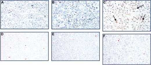 Figure 7. Apoptosis in tumor xenografts as measured by TUNEL staining. Tumors harvested from mice after 21 days of treatment were fixed in formaldehyde, deparaffinized, and subjected to immunohistochemical analysis. Shown are TUNEL stains of CAG myeloma xenografts with short telomeres after intratumoral treatment with (A) PBS, (B) 227 (10 nmol), and (C) GRN163 (10 nmol) 5 times a week for 3 weeks. These are compared with TUNEL stains of HT tumor xenografts with long telomeres after intratumoral treatment with (D) PBS, (E) 227, or (F) GRN163 on the same schedule. Apoptotic cells are indicated in brown (arrows). Original magnification, × 40.