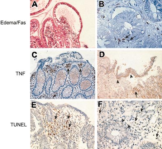 Figure 1. Pathologic study of GvHD in the digestive tract. (A) The superficial epithelium of a villous is split from the lamina propria, with a large area of subepithelial edema. Hematoxylin-eosin, original magnification × 400. (B) Immunostaining with an antibody directed against CD95. Cells located in the glandular epithelium (arrows) as cells located in the lamina propria are stained. Indirect immunoperoxydase, original magnification × 800. (C-D) Immunostaining with an antibody directed against TNF. (C) Numerous stained cells are found in the upper part of the lamina propria (arrows). Indirect immunoperoxidase, original magnification × 250. (D) Full split of the superficial epithelial layer; the cells expressing TNF are mainly located in the split epithelium (arrowheads) or just beneath (arrow). Indirect immunoperoxidase, original magnification × 40. (E-F) TUNEL reactions. (E) Apoptotic bodies (arrows) are mainly located in the upper part of the lamina propria, in close vicinity to the edematous area; original magnification × 250. (F) Apoptotic bodies are mainly found in the lamina propria (arrows), but few apoptotic bodies are also found in the glandular epithelium (arrowheads); original magnification × 600.