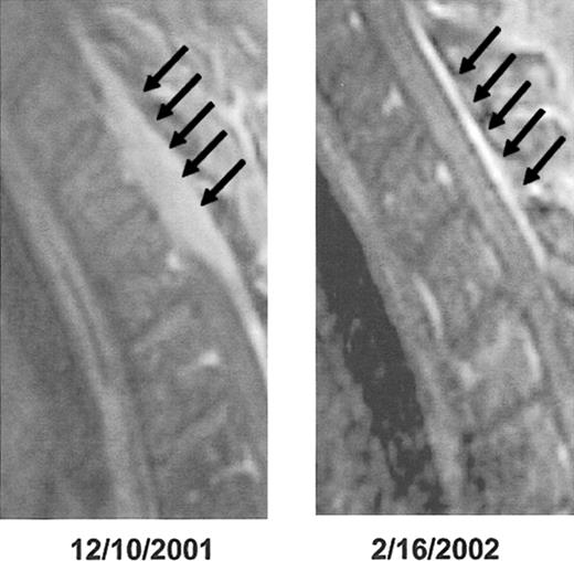 Figure 8. Cord compression detected by MRI. This is an example of rapid resolution of extensive spinal cord compression as a result of combination chemotherapy with DT PACE47 (dexamethasone 40 mg daily × 4, thalidomide 400 mg daily × 4, 4-day continuous intravenous infusions of cisplatin 10 mg/m2/d, Adriamycin 10 mg/m2/d, cyclophosphamide 400 mg/m2/d, and etoposide 40 mg/m2/d). Epidural disease from multiple myeloma responding to treatment: post-gadolinium T1-weighted MRI before (left) and after (right) treatment of epidural disease (arrows). Only a thin “stripe” of enhancing tissue remains after treatment.
