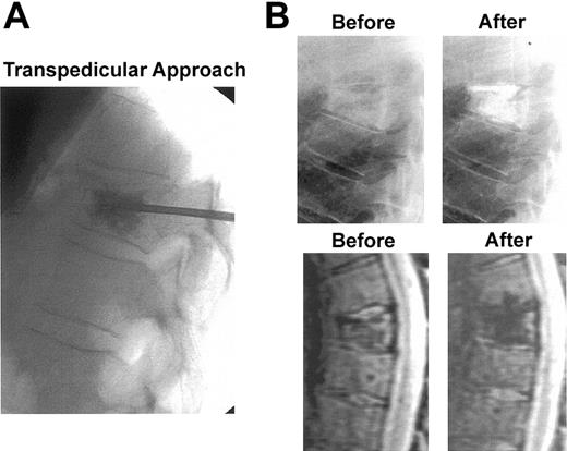 Figure 9. Compression fracture with vertebroplasty intervention. (A) X-ray procedure using standard transpedicular approach. (B) X-ray (top panels) and short inversion imaging (STIR)–weighted MRI sagittal images (bottom panels) of a compression fracture of T7 before and after vertebroplasty. Immediate and dramatic pain relief because of improved mechanical stability as well as the polymethylmethacrylate's neurotoxic effects.133