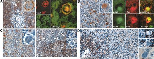 Figure 1. Immunolabeling for B-cell–associated signaling molecules in classical Hodgkin disease. All staining was performed on paraffin biopsies by immunoperoxidase or double immunofluorescent techniques. (A) Left: Reed-Sternberg cells are negative for Lyn kinase (white arrows), which is confined to reactive lymphocytes. A single Reed-Sternberg cell that shows cell-membrane–associated staining is seen in the inset. Right: Double immunofluorescent staining in an exceptional case of mixed cellularity disease (no. 17 in Table 1) in which Lyn was expressed (CD30, red; Lyn, green) confirms that this kinase is present in Reed-Sternberg cells. (B) Left: Heterogeneous immunostaining for Fyn in Reed-Sternberg cells in a case of mixed cellularity (no. 16 in Table 1), comprising both positive (black arrows) and negative tumor cells (white arrow). The inset shows clear cytoplasmic staining in a multinucleated Reed-Sternberg cell. Right: Double immunofluorescent labeling for CD15 (green) and Fyn (red) confirms the expression of Fyn by Reed-Sternberg cells. (C) Left: Reed-Sternberg cells (white arrows) and accompanying T cells are Syk negative, contrasting with Syk-positive reactive B cells. The inset shows a Syk-negative multinucleated Reed-Sternberg cell. Right: Reed-Sternberg cells are consistently BLNK negative (white arrows), as highlighted in the insets, contrasting with positive-reactive B cells. (D) Left and right: Reed-Sternberg cells are PLC-γ2 negative (white arrows), as highlighted in the insets. Reactive B cells are strongly PLC-γ2 positive. Original magnifications: × 20 (C, right panel), × 40 (A, left panel; B, left panel; C, left panel and right panel insets; and D), and × 60 (A, left panel inset and right panels; B, left panel inset and right panels; and C, left panel inset).