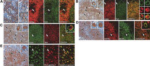 Figure 2. Immunolabeling for B-cell–associated signaling molecules in lymphocyte predominance Hodgkin disease. All staining was performed on paraffin biopsies by immunoperoxidase or double immunofluorescent techniques. (A) Left: Two cases of lymphocyte predominance Hodgkin disease (nos. 4 and 7 in Table 1), showing Lyn-negative (white arrows) and Lyn-positive (black arrows) L&H cells. Right: Double immunofluorescent staining of another case (no. 6 in Table 1) shows an L&H cell (white arrow) that is CD79a positive but Lyn negative. (B) Left: Many L&H cells are Fyn positive (black arrows) in a case of lymphocyte predominance Hodgkin disease (no. 14 in Table 1) as seen at higher magnification in the insets. Right: Double immunofluorescent staining for CD20 (red) and Fyn (green) confirms coexpression of these markers in L&H cells (white arrows). The numerous mantle zone B cells in this field are also strongly CD20/Fyn positive. (C) Left: Strong reactivity of L&H cells (black arrows) for Syk, as seen at higher magnification in the insets. Right: Double immunofluorescent labeling confirms the coexpression of CD20 (green, membrane associated) and Syk (red, cytoplasmic) in L&H cells (white arrows). (D) Left: Numerous strongly BLNK-positive L&H cells (black arrows), seen at higher magnification in the insets, lie within nodules of BLNK-positive B cells. Right: Double immunofluorescence for CD79a (red) and BLNK (green) confirms coexpression of these markers in L&H cells (white arrows and inset). (E) Left: L&H cells are strongly PLC-γ2 positive (as seen at higher power in the inset). Right: Double immunofluorescence shows coexpression of CD20 (green, membrane associated) and PLC-γ2 (red, intracellular) in L&H cells (arrows). Original magnifications: × 20 (A-D, E left panel), × 40 (A-E insets, E right panel).