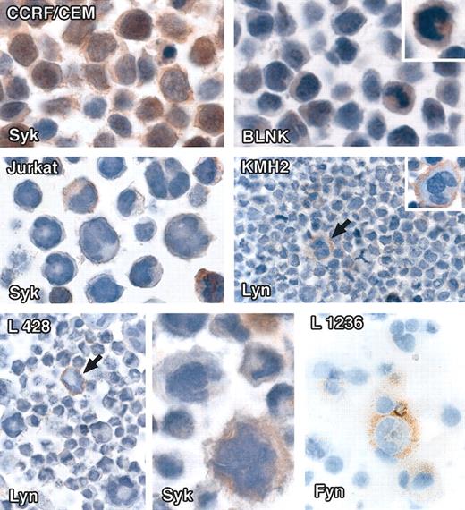 Figure 3. Immunostaining of cell lines for intracellular signaling molecules. All staining was performed on cell pellets and/or cytospins by the immunoperoxidase technique. (Top row) Left: The T-cell lymphoma line CCRF/CEM shows cytoplasmic and nuclear staining with anti-Syk antibody. Right: Scattered cells stain weakly with anti-BLNK. (Middle row) Left: Scattered cells in the Jurkat T-cell lymphoma line show weak Syk-cytoplasmic labeling. Right: Lyn membrane-associated labeling of rare cells in the Hodgkin disease cell line KMH2 (arrowed). (Bottom row) Left and center: Single cells in the L428 Hodgkin disease cell line show membrane-associated staining for Lyn (arrowed) and weak cytoplasmic labeling for Syk. Right: The periphery of a single cell in the L1236 Hodgkin disease cell line is stained for Fyn. Original magnifications: × 40 (top, middle, and left and right panels of bottom row), × 60 (bottom row, center panel).