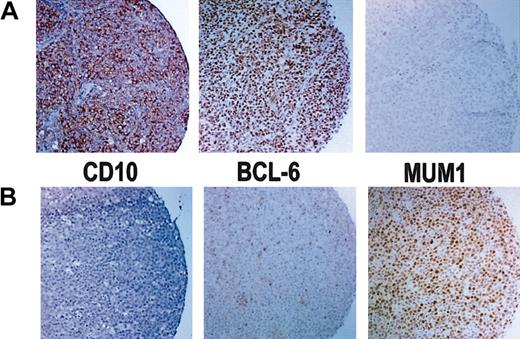 Figure 2. Results of immunoperoxidase staining. (A) Immunoperoxidase stains of a GCB case that is positive for CD10 and bcl-6 but negative for MUM1. (B) Immunoperoxidase stains of a non-GCB case that is negative for CD10 but shows rare bcl-6+ cells and is positive for MUM1. Original magnification, × 100.