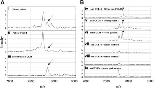 Figure 1. SELDI-TOF mass spectra of profiling and antibody capture experiments. (A) Weak cation exchange (WCX2) ProteinChip array. Plasma samples of a Gaucher patient before (i) and after (ii) treatment and a control experiment with recombinant CCL18 in 0.5% (wt/vol) bovine serum albumin (iii). Mass range 7000 to 8500 m/z. (B) PS20 ProteinChip array coated with monoclonal antibodies. Anti-CCL18 (iv-viii) and (as a control) anti–TNF-α (ix). Recombinant CCL18 (iv), sera of Gaucher patients (v-vi), control sera (vii-viii) and a pool of patient samples (ix) were exposed to the antibody-coated arrays. Mass range 7000 to 8500 m/z.