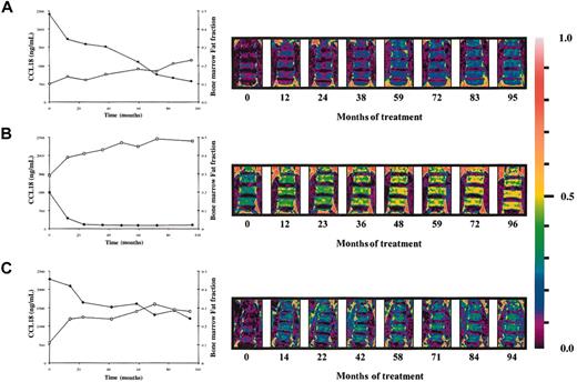 Figure 5. Relationship between decrease in CCL18 plasma levels and lumbar spine bone marrow fat fraction. (A-C) Inverse relationship between the decrease in plasma CCL18 levels and increase in lumbar spine marrow fat fraction on enzyme replacement therapy. Patient A: Spearman ρ –0.952; P = .0011; patient B: Spearman ρ –0.802; P = .0218; patient C: Spearman ρ –0.815; P = .0108 (•, CCL18; □, bone marrow fat fraction). Right hand side shows changes in the bone marrow fat fraction of the lumbar spine during enzyme replacement therapy as visualized by QCSI.