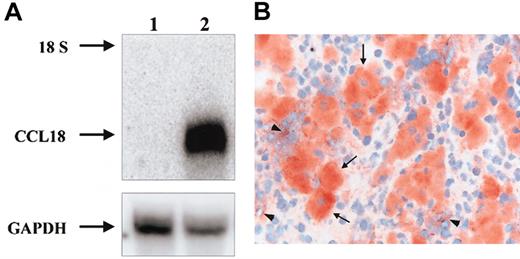 Figure 6. Expression of CCL18 in Gaucher spleen. (A) Detection of CCL18 mRNA in Gaucher spleen by Northern blot analysis. Control and Gaucher spleen total RNA was analyzed by Northern blotting as described in “Patients, materials, and methods.” Lane 1, control spleen; lane 2, Gaucher spleen. The probes used were full-length CCL18 cDNA and GAPDH as an RNA control. The 18S ribosomal band is indicated. (B) Detection of CCL18 protein by immunohistochemistry in Gaucher spleen. Clustered large swollen cells are Gaucher cells and label massively for CCL18 protein (arrows). Some surrounding spleen cells also show some labeling (arrowheads). Original magnification × 400.