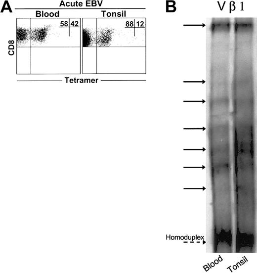 Figure 1. Clonal analysis of expanded CD8+ T cells from AIM blood and tonsil samples. (A) Representative dot plot of CD8 versus tetramer (RAK) staining in matched blood and tonsil samples. Heteroduplex analysis was used to assess the clonality of purified CD8+ T cells from matched blood and tonsil samples taken from 3 AIM patients. PCR reactions were performed for 23 different Vβ families in the blood and tonsils of each patient. (B) Data from a representative Vβ family showing heteroduplex bands shared between CD8+ T cell blood and tonsils, as indicated by solid arrows, are shown. Dashed arrow indicates the homoduplex band.