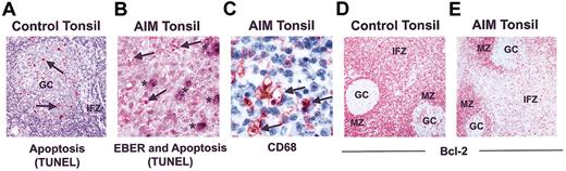 Figure 4. Apoptosis in control and AIM tonsil samples. (A) Apoptotic cells as identified by TUNEL in control tonsils are predominantly in the GCs and not in the IFZ (original magnification × 50). (B) Apoptotic cells in AIM tonsils, defined by TUNEL staining and indicated by arrows, do not costain with EBER, indicated by asterisks (original magnification × 400). (C) CD68 staining showing apoptotic cells with condensed nuclei being engulfed by macrophages (original magnification × 400). Bcl-2 expression in representative (D) control and (E) AIM tonsils is shown. Cells in the IFZ and MZ of control tonsils expressed high levels of Bcl-2, whereas GCs contained few positive cells (original magnification × 100). Results are representative of 14 AIM and 8 control tonsils investigated.