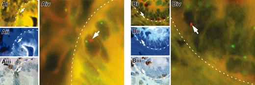 Figure 1. FISH and immunostaining results on identical duodenal sections of 2 female patients who underwent allogeneic, non–T-cell–depleted bone marrow transplantation from male sibling donors. The epithelial basal membrane appears with a broken line in all the images. (Ai) In the epithelium, a cell with a red signal (white arrow) corresponds to Y-chromosome labeling (FISH; original magnification, × 630). X chromosomes are stained green. (Aii) The same cell (white arrow) is not stained with the anticytokeratin antibody (indirect immunofluorescence; original magnification, × 630). Epithelial cells are stained white on a blue background (open black arrowhead). (Aiii) The same cell (white arrow) is stained with the anti-CD45 antibody (indirect immunoperoxidase; original magnification, × 630). A lymphoid cell is stained brown in the lamina propria (white arrowhead). (Aiv) Higher magnification of panel Ai centered on the XY cell in the epithelium (FISH; original magnification, × 3150). X chromosome, green; Y chromosome, red. (Bi) In the epithelium, a cell with a red signal (white arrow) corresponds to Y-chromosome labeling (FISH; original magnification, × 630). X chromosomes are stained green. (Bii) The same cell (white arrow) is not stained with the anticytokeratin antibody (indirect immunofluorescence; original magnification, × 630). (Biii) The same cell (white arrow) is not stained with the anti-CD45 antibody (indirect immunoperoxidase; original magnification, × 630). (Biv) Higher magnification of panel Bi centered on the XY cell in the epithelium (FISH; original magnification, × 3150). X chromosome, green; Y chromosome, red.