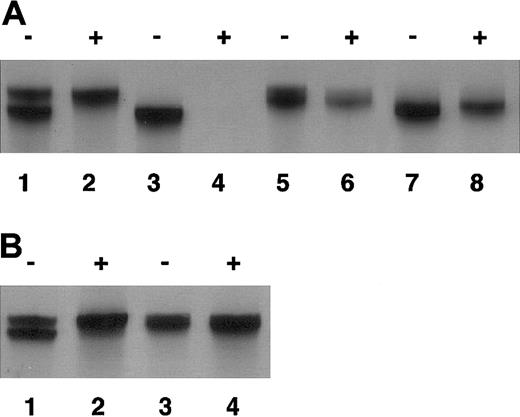 Figure 2. Nonrandom X-chromosome inactivation of the patient. DNA was extracted from peripheral blood (A) and oral mucosal cells (B) of the family members. Exon 1 of the androgen receptor, which contains CAG repeat, was amplified as described in “Study design” with (+) or without (–) the digestion by methylation-sensitive HpaII before amplification. (A) Lane 1 and 2 indicate the patient; lane 3 and 4, her father; lane 5 and 6, her mother; and lane 7 and 8, her paternal grandmother. (B) Lane 1 and 2 indicate the patient; and lane 3 and 4, her mother.