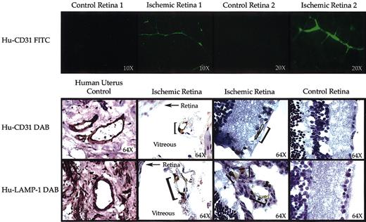 Figure 2. Induction of retinal neovascularization containing human endothelial cells. (Top) Mice that received xenotransplants were perfused with anti-human CD31 (FITC) followed by 2 wash perfusions. Flat mounts of the retina were examined by confocal fluorescence microscopy. Panels show fluorescence micrographs of noninjured control retinas versus injured ischemic retinas isolated from the same animal. Only injured eyes stained positive (green) for human CD31. Original magnification for control and ischemic retina 1, × 10; for control and ischemic retina 2, × 20. (Bottom) Immunohistochemistry staining for human CD31 and human LAMP-1 was performed on human uterus as a positive control (original magnification, × 64), noninjured retinas from the same animal that received xenotransplants served as negative controls (control eye, original magnification × 64), and injured ischemic retinas (original magnification, × 64). Human endothelial cells (brown stained cells demarcated with a bracket) were detected only in the injured retinas. Some of the new vessels were formed within the vitreous of the injured eyes. In those sections the retina is annotated with an arrow and the vitreous in clearly labeled.