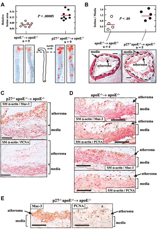 Figure 1. Reconstitution of apoE–/– mice with BM lacking p27 accelerates diet-induced atherosclerosis. One month after transplantation, mice were challenged with a high-cholesterol diet for 2 months. Animals were then killed and aortic tissue was retrieved to quantify atherosclerosis (A, B) and for immunohistochemical analysis (C-E). Results in A and B are given as mean ± SE, and differences between groups were evaluated using 2-tailed, unpaired Student t test. (A) The aorta was removed from the heart to the renal artery and was stained with Oil Red O. The area of atheroma (red staining) was quantified by computerized planimetry. Results are represented relative to total aortic area. The photomicrographs show representative examples. (B) Cross-sections of the aortic arch region were analyzed to measure the area of atheroma (intimal lesion) and media to determine the intima-to-media ratio. The red horizontal bars show the average value in each group. The representative photomicrographs in B show specimens doubly immunostained with antibodies against the macrophage-specific Mac-3 protein (brown signal) and the smooth muscle–specific α isoform of actin (SMα-actin; red signal). The discontinuous lines mark the boundary between the tunica media and the atheroma. The bars represent 0.2 mm. (C-E) Immunohistochemistry of aortic arch cross-sections. Each pair of photomicrographs correspond to immediately adjacent cross-sections of the same mouse (bars represent 100 μm). Mac-3 and PCNA are shown in brown, and SMα-actin in red. Analysis included double immunohistochemistry using the indicated pairs of antibodies (C, D) and single immunostaining using anti–Mac-3 and anti-PCNA antibodies (E). For double immunhistochemistry, specimens were first stained for either PCNA or Mac-3, and then with the alkaline phosphatase– conjugated anti–SMα-actin antibody. In both groups of mice, abundant immunoreactivity for Mac-3 and SMα-actin is detected within the atheroma and the media, respectively, and PCNA expression predominates in macrophage-rich regions of atheromas.