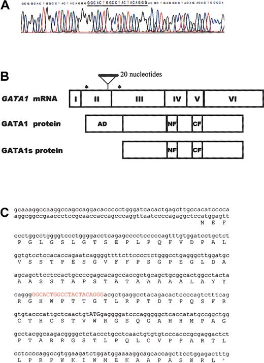 Figure 1. An identical GATA1 mutation in twins with TMD accompanying DS. (A) Direct sequence analysis of cDNA and genomic DNA from TMD blast cells of identical twins with DS showed that 20 nucleotides of the duplicated sequences were inserted in exon 2 of the GATA1 gene in both patients. (B-C) The mutation resulted in the introduction of a premature stop codon in the gene sequence encoding the N-terminal activation domain. The predicted protein, GATA-1s, lacks the transactivation domain.