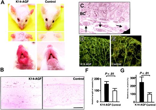 Figure 1. Increased number of microvessels in K14-AGF transgenic mice. (A) Gross appearance of the K14-AGF mouse and a control showing that the skin of ears and snout of K14-AGF mice are red compared with controls. (B) Immunohistochemical analysis with anti–PECAM-1 antibody of ear skin from K14-AGF mouse and a control. Increased PECAM-1+ microvessels (purple) are detected in the dermis and subcutaneous layers of K14-AGF mouse. Bar indicates 100 μm. (C) Electron microscopic analysis (original magnification, × 1700) shows that increased vessels are capillary-sized (arrows) in the K14-AGF mouse. BC indicates epidermal basal cells. (D-E) Representative photograph of blood vessels in the ear from the K14-AGF mouse (D) and controls (E) stained with fluorescein-labeled Lycopersicon esculentum lectin. Abundant capillary-sized vessels in the K14-AGF mouse are detected. (F-G) Quantitative analysis for the number of vessels shown in panels D and E. Length of vessels (F) and number of vessel joints (G) in K14-AGF transgenic mice (▪) relative to controls (□) are shown as percentages. Columns represent mean values + SD (n = 5).