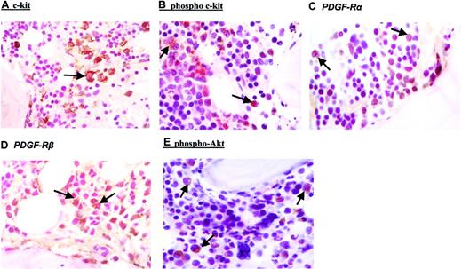 Figure 1. Immunohistochemical analysis of leukemic blasts from bone marrow biopsies. Bone marrow biopsies were taken before start of imatinib therapy. Immunohistochemistry was performed by applying the peroxidase/diaminobenzidine (DAB) method for anti–c-kit (A), antiphosphotyrosine c-kit (B), anti–PDGF-Rα (C), anti–PDGF-Rβ (D), and antiphospho-Akt (E). The specificity of positive phospho-Akt staining was controlled by the use of a specific blocking peptide (data not shown). Arrows indicate positive staining of AML blasts. Each figure shows a representative analysis of a total of 20. Original magnification, × 100.