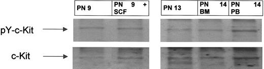 Figure 2. c-kit is tyrosine phosphorylated in peripheral blood and bone marrow blasts from patients with AML. BM aspirates and peripheral blood sampling were performed at screening visits before start of imatinib therapy. MNCs were separated, and whole cell lysates were prepared as described in “Patients, materials, and methods.” Western blot analysis was performed by using an antiphosphotyrosine c-kit antibody. To control for equal loading, the blot was stripped and reprobed with anti–c-kit antibody. Shown are representative results from 3 patients (PN 9, 13, and 14). AML blasts obtained from PN 9 were incubated with and without SCF (100 ng/mL) for 15 minutes. Arrows indicate the position of the 160-kD isoform of c-kit.
