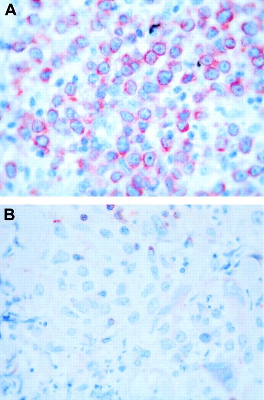 Figure 2. Bcl-2 staining. (A) Case with a round-cell morphology and high bcl-2 expression. (B) Case with a cleaved-cell morphology and negative bcl-2 staining. Original magnification, × 400.