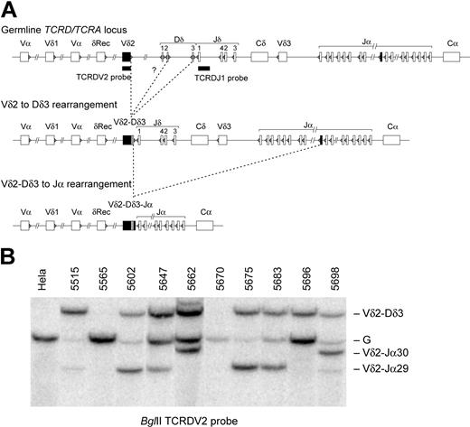 Figure 1. TCRD/A gene rearrangements in precursor-B–ALL. (A) Consecutive rearrangements in the TCRD/A locus involving the Vδ2 gene segment that are characteristic for precursor-B–ALL. The main pathway concerns consecutive Vδ2-Dδ3 → Vδ2-Dδ3-Jα recombinations. Dδ2-Dδ3 and Dδ2-Jα gene rearrangements can also occur, albeit at much lower frequencies. Solid boxes below the gene segments represent the probes used for Southern blot hybridization. (B) Southern blot analysis with TCRDV2 probe in 10 precursor-B–ALL samples. Vδ2-Dδ3 and/or Vδ2-Jα29 gene rearrangements in cases 5602, 5675, 5683, and 5696 are monoclonal. The presence of several rearranged bands of different densities in cases 5515, 5647, 5662, and 5698 is consistent with oligoclonality. Both Vδ2 alleles in case 5670 are deleted, while case 5565 has both Vδ2 alleles in germline (G) configuration.