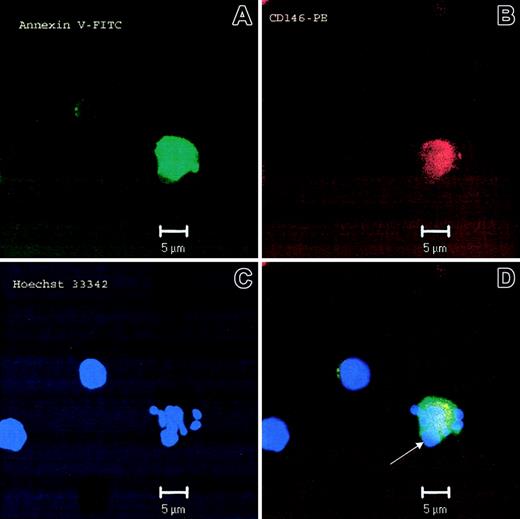 Figure 3. Circulating ECs display an apoptotic phenotype. Microphotograph of an apoptotic EC from a patient with SLE. Annexin V was visualized with FITC-conjugated Annexin V, CD146 was visualized by anti-CD146 conjugated to phycoerythrin, and nuclear material was visualized with Hoechst 33342. (A-C) Micrographs show the staining with each individual fluorochrome and the composite image (D). Panel C displays evidence of nuclear fragmentation, characteristic of apoptosis. Arrowhead denotes a prominent surface bleb containing nuclear material, characteristic of apoptosis. The other 2 cells in the figure represent cells that are CD146– and, therefore, not of endothelial origin.