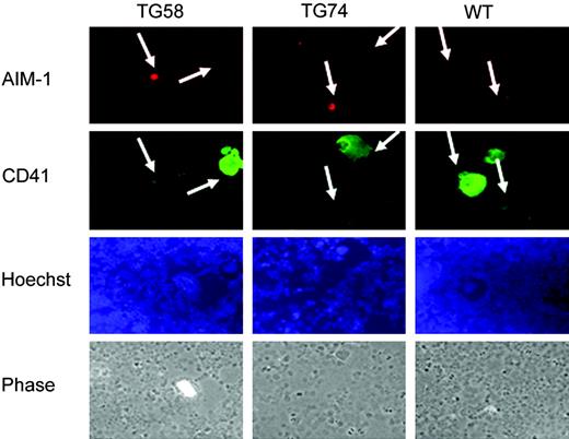 Figure 7. High Aurora-B/AIM-1 protein level is only detected in transgenic, small, CD41+ megakaryocytes. Immunohistochemical staining of bone marrow cells isolated from wild-type or transgenic mice. Aurora-B/AIM-1 was stained with rhodamine-conjugated antibody (red). The megakaryocyte surface marker CD41 was stained with FITC (green). Cell nuclei were stained with Hoechst (blue). Large and small CD41+ cells (megakaryocytes) are indicated with arrows. Small CD41+ cells have diameters in the range observed for all other bone marrow cells (noted by phase-contrast microscopy). Small megakaryocytes in transgenic mice showed strong, diffuse Aurora-B/AIM-1 staining. Original magnification, × 200.
