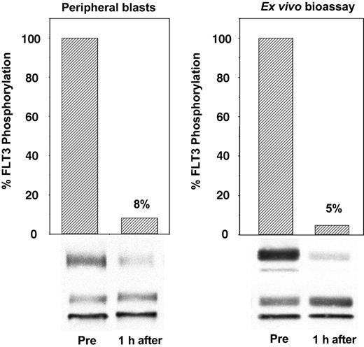 Figure 2. Ex vivo bioassay for FLT3 inhibition. The immunoblot on the left was derived from peripheral blood leukemia cells isolated from a patient before and 1 hour after the initial dose of CEP-701. The blot on the right was obtained from TF/ITD cells exposed to the plasma from the same patient at the same time point. FLT3 was immunoprecipitated from detergent extracts of leukemia cells, resolved with SDS-PAGE, and transferred to PVDF membranes. The phosphorylated state of the receptor (upper bands, P-FLT3) was determined by immunoblotting with an antiphosphotyrosine antibody. Membranes were then stripped and reprobed with anti-FLT3 antibody to assess total FLT3 protein (lower bands, FLT3). Densitometric analysis of phosphorylated FLT3, normalized for the amount of total FLT3, is displayed graphically with columns.