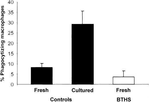 Figure 5. Uptake of BTHS neutrophils by human monocyte-derived macrophages. Freshly purified control granulocytes (fresh) and granulocytes from the same donor after overnight culture with more than 70% annexin-V binding (cultured) were incubated with human monocyte–derived macrophages for 30 minutes, and the percentage of phagocytizing macrophages was estimated as described in “Patients, materials, and methods” (▪). Freshly purified granulocytes from a BTHS patient with more than 60% annexin-V binding were used to compare with the control granulocytes (□). Uptake of cultured apoptotic BTHS granulocytes was similar compared with cultured control cells (not shown). Results shown (mean ± SD) are representative of experiments performed on different occasions with cells from 4 control individuals and 3 patients in total.