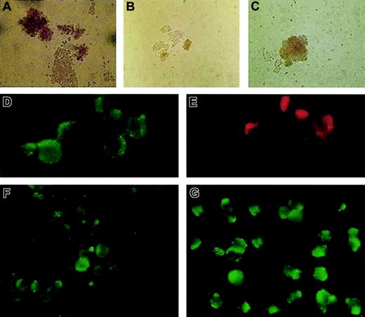 Figure 1. BFU-E growth in vitro and immunofluorescence staining of fixed and permeabilized patient's erythroblasts compared with healthy control. Healthy control (A) and the patient's (B) BFU-Es were grown in the presence of Epo, without Fe-SIH; the addition of 10 μM Fe-SIH rescued the growth of the patient's BFU-E (C). DMT1 (D) and TfR (E) were colocalized in EEA1–positive endosomes in the patient's erythroblasts. The expression of DMT1 in the patient's erythroblasts (F) was decreased compared with healthy control (G). Original magnifications: × 200 for panels A-C, × 1000 for panels D-G.