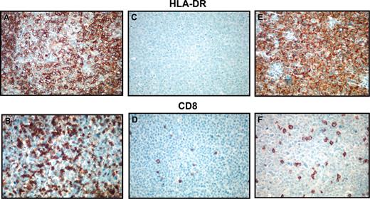 Figure 6. Immunohistochemical detection of HLA-DR and CD8. Photomicrographs demonstrating immunohistochemical detection of HLA-DR (A,C,E) and CD8 (B,D,F). Panels A and B demonstrate an HLA-DR+ case with brisk CD8+ cytotoxic T-cell response. Panels C and D show an HLA-DR- case with few CD8+ tumor-infiltrating lymphocytes. Panels E and F demonstrate a microarray HLA-DRA- case that has staining for the protein in an unusual cytoplasmic pattern. This case also demonstrates low numbers of CD8+ cytotoxic T cells, indicating possible aberrant protein localization or function. Original magnification, ×100.