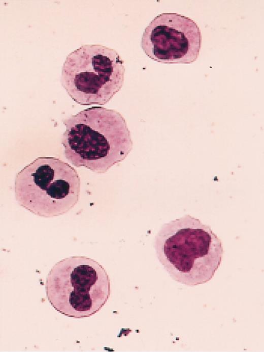 Figure 4. Abnormal morphology of granulocytes produced in mice engrafted with human MDS cells. Shown is a representative Wright-Giemsa-stained cytospin preparation of FACS-sorted human CD45/71+ cells isolated from a mouse injected 3 weeks previously with cells from patient 3. Original magnification, × 63.