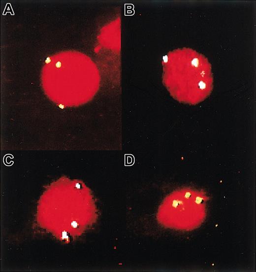 Figure 5. FISH detection of trisomy 8+ cells produced in mice that received transplants of MDS cells. Panel A shows a cytospin of starting cells from patient 9, and panel B shows some of the human CD45/71+ cells isolated by FACS from the BM of a mouse injected 3 weeks previously with these cells. (C-D) Examples of cells from a mouse injected 3 and 5 weeks previously with cells from patient 1. Trisomy 8+ cells were identified by the detection of 3 fluorescent signals in single nuclei. Original magnifications, × 100 for all panels.