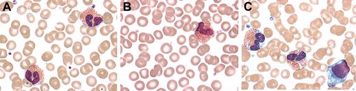 Figure 1. Peripheral blood smears. Representative peripheral blood eosinophils from a patient with FE (A), an NL family member (B), and a patient with HES (C) stained with modified Wright stain (original magnification, × 1000). There is evidence of dysplasia with areas of cytoplasmic clearing only in the eosinophils from the patient with HES.