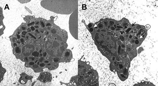 Figure 2. Electron micrographs of representative eosinophils from 2 patients with FE. Only one FE patient had any evidence of altered eosinophil morphology, consisting of piecemeal degranulation (arrow) in approximately 20% of his eosinophils (B). White arrows indicate lipid bodies. Original magnification, × 5000.