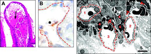 Figure 1. Pathologic features of capillary damage in human digestive graft-versus-host disease. (A) Blood suffusion (arrow) around capillary loops (white broken lines) in the upper part of duodenal villi. Paraffin section with hematoxylineosin stain; original magnification, × 300. (B) High magnification of a capillary, with partial detachment of an endothelial cell (asterisk). Indirect immunoperoxydase with an antibody directed against CD31; original magnification, × 1200. (C) Ultrastructural aspect of close capillary sections in the lamina propria of a duodenal biopsy. 1: capillary section with intact endothelium and basal membrane; 2: capillary section with endothelial cytoplasm of irregular thickness around the capillary lumen, without basal membrane rupture; 3: capillary section with discontinuity in the basal membrane () and endothelial cytoplasmic cover; and 4: extravased red blood cells. Insert: higher magnification of basal membrane rupture.