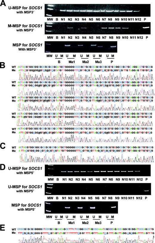 Figure 2. Methylation-specific polymerase chain reaction (MSP) for SOCS1 (A) MSP for the unmethylated allele (U-MSP) and methylated allele (M-MSP), showing that with the MSP3′ primers, 6 normal peripheral bloods (N2, N4, N7, N8, N9, and N10) and 2 marrows (Ma1 and Ma3) showed methylation signals. MW indicates molecular weight control; B, blank; P, positive control of methylated DNA; U, U-MSP; M, M-MSP; N, normal peripheral blood; and Ma, normal marrow. (B) Sequencing of SOCS1 in 5 bisulfite-converted peripheral blood controls (N7 to N10 and Ma3) showing methylation signals with primer set MSP3′. The DNA sequence of the “methylated” (Me) PCR product was aligned and compared with the germ line sequence of the wild-type DNA (WT). Methylated cytosine residues in CpG dinucleotide remained as C, whereas unmethylated cytosine read as T after bisulfite conversion. Underlined N suggested hemizygous methylation in a CpG island. Note the presence of many TG islands, representing unmethylated CpG dinucleotides. (C) Sequencing of the methylated PCR product with the MSP3′ primers of the methylated positive control. (D) MSP for SOCS1 using the MSP5′ primers. None of the normal peripheral blood and marrow samples showed positive methylation signals. (E) Sequencing of the methylated PCR product with MSP5′ primers from the methylated control DNA, showing complete methylation.