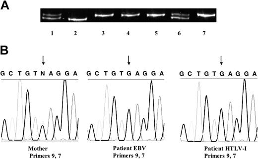 Figure 4. Reversion mosaicism of NEMO. (A) Human androgen receptor trinucleotide repeat polymorphism. Cells from the patient's mother (lanes 1, 6, and 7), the patient's father (lane 2), and the patient (PBMCs, lane 3; EBV-transformed cells, lane 4; and HTLV-I-transformed cells, lane 5) were used as templates. The patient's cells all had the same allele, which matched one of his mother's. This allele was methylated and inactivated in the mother, which was shown by an X-inactivation assay using HpaII (with HpaII, lane 7; without HpaII, lane 6). (B) A single-nucleotide polymorphism in the pseudogene delta NEMO in the patient and his mother. The mother is heterozygous G/C, whereas both EBV- and HTLV-I-transformed cells from the patient had G. The arrows indicate the single-nucleotide polymorphism.