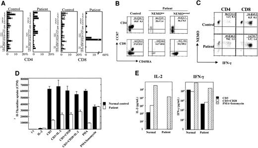 Figure 6. Analysis of the XL-EDA-ID patient's T cells. (A) TCR Vβ repertoire analysis of the patient's CD4+ and CD8+ cells. The patient's PBMCs were stained for the TCR Vβ panel and CD4 or CD8 as described by Kobayashi et al.29 The healthy controls consisted of children 1 to 10 years old (n = 10). The values are shown as mean ± SD. (B) Naive and memory phenotypes of the patient's T cells. PBMCs from the patient and control were stained with NEMO, CCR7, CD45RA, and CD4 or CD8. Cells gated on NEMOlow or NEMOnormal of CD4 or CD8 are shown. (C) Reduced IFN-γ production of NEMOlow T cells. The patient and control PBMCs were stimulated with PMA/ionomycin/monensin for 6 hours and stained for intracellular IFN-γ along with NEMO and CD4 or CD8. Cells gated on CD4 or CD8 are shown. (D) Proliferation assay of PBMCs stimulated by an anti-CD3 mAb plus an anti-CD28 mAb. PBMCs from the patient or healthy controls were stimulated for 48 hours with an anti-CD3 mAb, an anti-CD3 mAb plus the anti-CD28 mAb ± IL-2 (100 IU/mL), PHA, or PMA/ionomycin. Data are shown as mean ± SD. (E) Reduced production of IL-2 and IFN-γ by anti-CD3 mAb plus anti-CD28 mAb. PBMCs from the patient or healthy controls were stimulated for 48 hours by the anti-CD3 mAb, anti-CD3 mAb plus anti-CD28 mAb, or PMA/ionomycin, and the supernatants were harvested for ELISA assays.