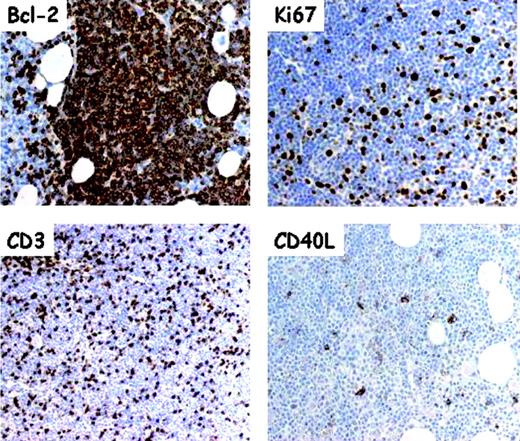 Figure 3. Serial section analysis of pseudofollicles in B-CLL bone marrow. Frozen tissue sections of a bone marrow trephine biopsy with heavy CLL infiltration were cut on slides covered with adhesive. All sections were subjected, before immunostaining, to antigen retrieval and developed using a sensitive avidinstreptavidin-peroxidase technique and standardized procedures. The monoclonal antibodies included anti-Bcl-2 (Ab124; Dako, Glostrup, Denmark), anti-Ki-67 (MIB-1; Dako), CD3 (Dako), and anti-CD40L (clone TRAP1; Pharmingen-Becton Dickinson, San Jose, CA). Virtually all cells are intensely Bcl-2+; pseudofollicles contain numerous Ki-67+ (ie, proliferating) elements that are interspersed with numerous CD3+ T cells, some being CD40L+. Original magnification for Bcl-2 and Ki67, × 250; for CD3 and CD40L, × 100.