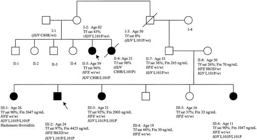 Figure 1. Abbreviated pedigree of Carolinas kinship A with juvenile hemochromatosis (JH). JH patients II-5 and II-6 were described in a previous report.9 Arrows designate JH index cases in respective sibships. Ages (in years) are those at time of manuscript preparation (or death); clinical and laboratory findings reflect observations at the time of diagnosis of JH patients or evaluation of corresponding family members. Tf sat indicates serum transferrin saturation; Ftn, serum ferritin concentration. Determined alleles of HFE and HJV are displayed without parentheses, deduced genotypes within parentheses. The arrows designate the subjects used for DNA analysis.