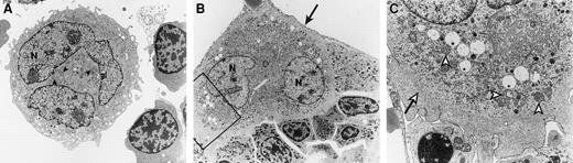 Figure 2. Ultrastructure of normal and ITP megakaryocytes. (A) Normal megakaryoblast (stage I megakaryocyte) showing a lobulated nucleus (N). In the cytoplasm, characteristic demarcation membrane system (asterisks) and normal mitochondria (arrowheads) can be found. Original magnification, × 3000. (B) Megakaryoblast of an ITP patient in the process of para-apoptosis; N indicates nucleus. The cell has an intact enlarged peripheral margin (large arrow). Original magnification, × 4500. (C) This inset of panel B shows a higher magnification with mitochondria, some of which are slightly swollen (open arrowheads) and others which have completely collapsed cristae, which appear as empty vacuoles (asterisks). The enlarged peripheral margin in the cytoplasm is free of organelles (open arrow). Original magnification, × 15 000.