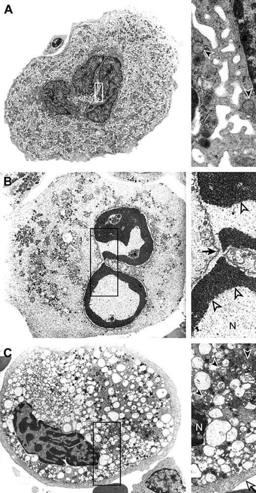 Figure 3. Ultrastructure of megakaryocytes in healthy control and ITP. (A) Mature megakaryocyte (stage III) from a healthy donor, showing the characteristic ultrastructure. The right panel shows a higher magnification of intact mitochondria (arrowheads) and a normal demarcation pattern. Original magnification, × 3000 (left panel); and × 18 000 (right panel). (B) Mature megakaryocyte of an ITP patient showing apoptotic characteristics. The right panel shows a detail of the nuclear fragmentation (arrow) and chromatin condensation to the margins of the nucleus (arrowheads). The cells shown in panels B-C are taken at a higher magnification than those in panel A. The shrinkage of the cells and rounding up has reduced cellular volume considerably. Original magnification, × 7000 (left panel); and × 18 000 (right panel). (C) Mature megakaryocyte of another ITP patient showing ultrastructural features of para-apoptosis. In the inset details are shown of cytoplasmic vacuolization, partly as a result of swollen mitochondria (arrowheads), dilation of endoplasmic reticulum, and dilation of the demarcation membrane system. The thick, enlarged peripheral margin (open arrow) in the cytoplasm lacks organelles. Original magnification, × 7000 (left panel); and × 18 000 (right panel). N indicates nucleus.