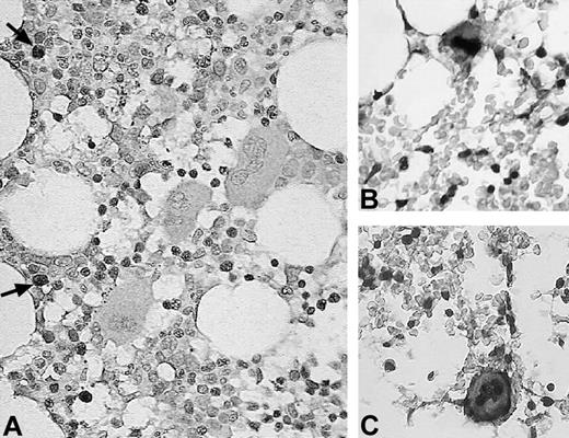 Figure 4. Immunohistochemical detection of activated caspase-3 in ITP megakaryocytes. (A) Normal bone marrow megakaryocytes are negative for activated caspase-3. Some neutrophil granulocytes are positive (arrows). (B-C) Megakaryocytes of 2 ITP patients with extensive ultrastructural features of apoptosis are shown. These megakaryocytes stain positive for activated caspase-3. Original magnification, × 400.