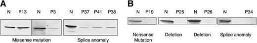 Figure 1. Western blot analysis of EBV-transformed cell lysates from WAS/XLT patients. Typical blots are shown. Patient numbers and descriptions of the mutations are shown in Table 1. (A) WASP-positive patients. (B) WASP-negative patients.