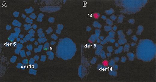 Figure 1. FISH detection of t(5;14)(q35;q32). Sequential hybridization of the 885A6 YAC (A), then of wcp14 (B) on the same metaphase. (A) The normal chromosome 55 and the derivative 5 (der 5) are identified by green signals (885A6 YAC) at 5q35. (B) The derivative 5 is characterized by a small red signal (wcp14) at 5q35, corresponding to the translocated fragment from chromosome 14. (A) The derivative 14 (der 14) is identified by a green signal at its telomeric end (14q32), corresponding to the translocated part of the YAC. (B) The derivative 14 and the normal chromosome 14 are identified by wcp14 (red signal). Original magnification, × 100.