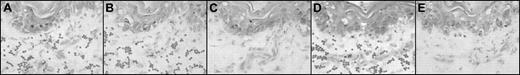 Figure 1. Photomicrographs of sequential sections after skin biopsy from a patient with acute cutaneous GVHD: enzyme and antibody treatments. Representative adherence assay results of experimental manipulations in sequential sections. (A-E) Methyl green-thionin stain; original magnification × 40. Digestion of matrix elements was performed for 30 minutes at 37°C with the following: heparitinase 2 from Flavobacterium heparinum (Calbiochem, La Jolla, CA), 5 mU/mL in buffer (100 mM Na acetate,10 mM Ca acetate, pH 7), keratanase from Pseudomonas species (Calbiochem), 0.5 U/mL in buffer (50 mM Tris HCl, pH 8), hyaluronidase from Streptomyces hyalurolyticus (Sigma, St.Louis, MO), 20 U/mL in PBS buffer. For antibody treatments, assays were performed on alternating sequential sections in the presence of the function-blocking mAb Hermes-1 (10 μg/mL; gift from Dr Brenda Sandmaier, Fred Hutchinson Cancer Research Center) or rat IgG2a isotype antibody (control). Note the characteristic appearance of arcuate, palisading adherent lymphocytes (dark dots) binding to dermal papillary structures (as shown in panels A, B, and D). (A) Heparitinase 2 treatment of skin section. (B) No enzyme treatment; section incubated with PBS (matched control). (C) Hyaluronidase treatment of skin section. (D) Keratanase treatment of skin section. (E) Lymphocytes incubated with anti-CD44 mAb Hermes-1. Notice the absence of binding in the section treated with hyaluronidase (C) and in the section in which the assay was performed in the presence of Hermes-1 (E).
